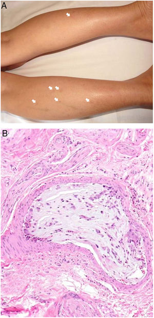 A: Émbolos de mixoma atrial. Máculas eritematosas, algunas residuales, salpicadas por la parte posterior de las extremidades inferiores. B: Émbolos de mixoma atrial. Dentro de una arteriola de la hipodermis se aprecia un material mixoide con numerosos vasos (H&E 20x).
