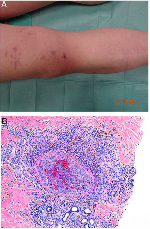 A: Angiosarcoma. Lesiones con aspecto livedoide o vasculítico. B: Oclusión de la luz del vaso por el crecimiento tumoral de un angiosarcoma (H&E 100x).
