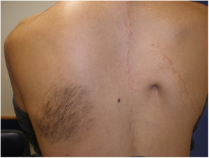 Mácula hiperpigmentada sobre la cual asienta vello situada a nivel escapular izquierdo. Obsérvese cicatriz quirúrgica adyacente, dado su antecedente de escoliosis severa.