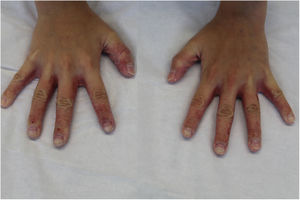 Lesiones similares en caras laterales y dorso de dedos de manos.