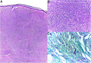 Histopatología. A,B (H&E): Dermis con acúmulos nodulares de células histioides, morfología fusiforme en patrón estoriforme. C: Coloración Fite-Faraco. Múltiples bacilos ácido-alcohol resistentes.