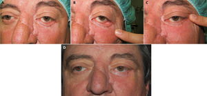 A-C) Varón de 56 años con un ectropión posquirúrgico y gran laxitud cantal externa y horizontal, además del componente cicatricial. D) Resultado postoperatorio tras cantoplastia mediante una tira tarsal (video, material adicional en web).