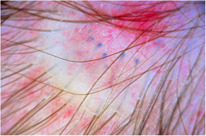 Dermatoscopia de la aplasia cutis membranosa. Signo de la translucencia: superficie brillante, vasos finos telangiectásicos y glóbulos azules que corresponden a bulbos pilosos. Además, se observa una ausencia de aperturas foliculares.