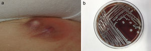 a) Absceso por S. lugdunensis en región inguinal, en paciente en tratamiento con adalimumab. b) Colonia de S. lugdunensis en agar sangre.