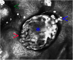 Microscopia confocal de reflectancia en escabiosis (campo de visión de 500×500μ). Estructura ovalada de refractabilidad heterogénea, que corresponde al cuerpo del Sarcoptes scabiei (asterisco). Se observan sus patas (flecha roja), estructuras ovoideas hiperrefráctiles de menor tamaño correspondientes a sus heces (flecha azul) y zonas hiporrefráctiles mal delimitadas que son parte del surco acarino (flecha verde). En esta imagen no se observan huevos ni ninfas.