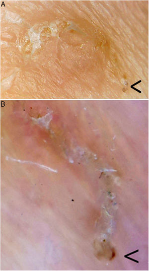 Surco acarino. En el extremo inferior derecho (flecha) se encontraría el parásito. A. Videomicroscopia (aproximadamente ×60-100 ?es difícil establecer la magnificación real, dado que es un dispositivo no homologado?, Jiusion 40-1000X). B. Dermatoscopia (×8, DermLite DL200, 3Gen). Se puede observar una mayor magnificación y resolución con la videomicroscopia.