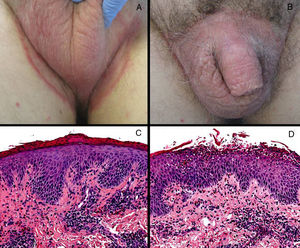 Clínica e histología. (A) Placa eritematosa de bordes bien definidos que afectaba la región púbica. (B) Eritema escrotal que se extiende a modo de placa a zona inguinal bilateral con borde eritematodescamativo más marcado. (C) Acantosis epidérmica con paraqueratosis extensa e infiltrado linfocitario perivascular (H-E, 200X). (D) Acantosis epidérmica con espongiosis neutrofílica, e infiltrados linfocitarios perivasculares dérmicos con eosinófilos (H-E 200X).