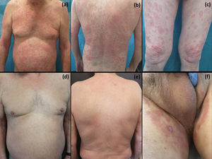 Evolución: exantema maculopapuloso en el tronco y las extremidades superiores (a y b). Lesiones eritematoedematosas anulares con borde más acenudado discretamente descamativas (c). Resolución de las lesiones en tronco y extremidades a las 2 semanas de suspender el pazopanib (d y e) con mejoría de las lesiones inguinoescrotales (f).