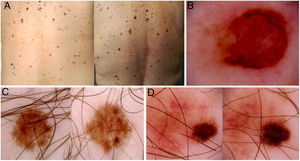 Imágenes de mapas corporales totales y de dermatoscopia de tres pacientes incluidos en el estudio. A) Se muestra la aparición de una lesión pigmentada palpable de novo en la región lumbar izquierda (círculo). B) Dermatoscopia de la lesión, mostrando asimetría estructural, policromía, retículo atípico y área central sin estructura. El estudio histopatológico demostró un melanoma con índice de Breslow 1,4 mm. C y D) Melanomas in situ diagnosticados por cambios dermatoscópicos en el seguimiento digital (crecimiento asimétrico, cambios focales de pigmentación, cambios focales de estructura).