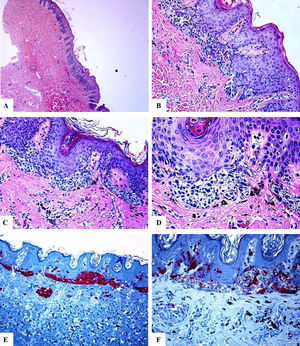 Características inmunohistoquímicas de un nevo melanocítico del área umbilical y con una atipia relacionada con su localización. A-D) Biopsia por afeitado de la piel umbilical que muestra un nevo melanocítico compuesto pequeño, simétrico y bien circunscrito. El crecimiento en el área de la unión revela un patrón lentiginoso y de nidos confluentes horizontalmente. En el interior de la dermis, se observan nidos melanocíticos en maduración, acompañados de fibroplasia y de algunos melanófagos. E) Tinción con melan-A intensa y difusa tanto de los melanocitos névicos localizados en la unión como de los localizados a nivel dérmico. F) Tinción parcheada de HMB45 de los melanocitos lentiginosos y de los nidos localizados a lo largo de la unión dermoepidérmica. En los nidos dérmicos se observan células raras positivas a HMB45. El HMB45 también tiñe para melanocitos solitarios ocasionales de la epidermis Aumento original: A) 20x; B) x200; C) x200; D) x 400; E) x100 y F) 200.