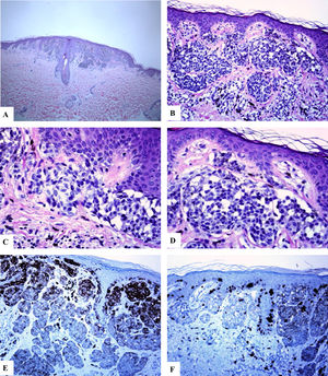 Características inmunohistoquímicas del nevo melanocítico de la línea axilar posterior con atipia relacionada con su localización. A-D) Se observa un nevo melanocítico simétrico compuesto que presenta un patrón predominantemente de nidos y algunos melanocitos névicos solitarios ubicados en la unión dermoepidérmica. Hay nidos de melanocitos que confluyen horizontalmente a nivel de la unión y que maduran siguiendo un gradiente decreciente en la profundidad de la dermis. Los melanocitos son cohesivos, están aumentados en tamaño y tienen un citoplasma claro con presencia de pigmento melánico fino. E) Se observa una reactividad difusa del HMB45 de los melanocitos de la unión, así como en los nidos de la dermis superficial. F) Se observa un Ki-67 positivo tanto de los queratinocitos de la unión como en los melanocitos. Aumento original: A) 20x; B) x100; C) x200; D) x 200; E) x200 y F) 200.