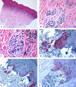 Características inmunohistoquímicas del nevo melanocítico acral del primer dedo del pie derecho (MANIAC). A-C) Las secciones muestran piel acral con un pequeño nevo melanocítico compuesto simétrico y bien delimitado. No hay confluencia de los nidos. Los melanocitos carecen de atipia citológica significativa. Dentro de la dermis hay fibroplasia y escasos melanófagos. D-E) El Melan-A tiñe para los melanocitos de la unión y dérmicos. Se observa un patrón lentiginoso con la extensión pagetoide ascendente de algunos melanocitos (sin atipia citológica) dispuestos como unidades solitarias en la capa espinosa (MANIAC). F) Se observa una tinción parcheada de HMB45 en los melanocitos con patrón lentiginoso a lo largo de la unión dermoepidérmica. El HMB45 también tiñe ocasionalmente melanocitos solitarios localizados en las zonas basales de la epidermis. Casi todos los melanocitos dérmicos carecen de expresión de la proteína HMB45, es decir, se observa una maduración inmunohistoquímica.Aumento original: A) 20x; B) x200; C) x200; D) x 400; E) x200 y F) 400.