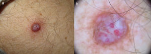 a) Lesión pápulo-nodular eritematoviolácea de consistencia firme en cara externa de brazo izquierdo. b) Imagen dermatoscópica en la que se aprecian estructuras blanquecinas sobre un fondo eritematoso, telangiectasias no arboriformes, vasos de aspecto glomerular, y un retículo marrón delicado de predominio periférico.