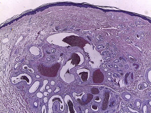 Proliferación vascular bien circunscrita en la dermis, con vasos revestidos por una única hilera de células endoteliales. Mientras que unos vasos presentan una pared fibromuscular gruesa, sin definitiva presencia de lámina elástica, otros vasos presentan una pared más delgada (H&E, ×40).