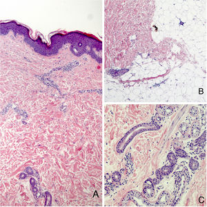Imagen histológica. A. Hematoxilina-Eosina ×10. B y C. Hematoxilina-Eosina ×40.