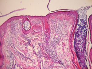Tinción con hematoxilina-eosina. Obsérvese la epidermis aplanada con focos de vacuolización de la capa basal y un engrosamiento de la membrana basal, dilataciones foliculares con tapones córneos y comedones. En la dermis, un infiltrado inflamatorio perivascular y perianexial. Gentileza Dra. A.C. Innocenti.