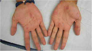 Lesiones palmares.