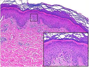 Corte histológico con detalle de espongiosis (recuadro negro).