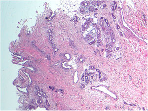 Imagen histopatológica (H&E ×10): proliferación en dermis profunda de estructuras ecrinas, capilares dilatados y focos de tejido adiposo.