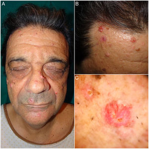 A y B) Imágenes clínicas de AS. Múltiples tumoraciones faciales de un color rosado de 5 a 25mm. C) Imagen dermatoscópica de un AS. Se identifican unos glóbulos amarillos pálidos sobre fondo eritematoso junto a unos vasos ramificados y tortuosos.