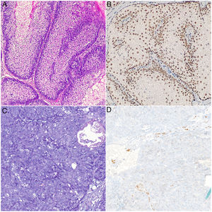 A y B) Imágenes histológicas de AS. Se aprecian unos lóbulos sebáceos constituidos por unas células basaloides en la periferia y unas células sebáceas maduras en el centro separados por unos tabiques de tejido conectivo. Positividad nuclear intacta para MSH6: A) Hematoxilina-eosina, ×20; B) Inmunohistoquímica para MSH6, ×20. C y D) Imágenes histológicas de CS. Células indiferenciadas con unos núcleos grandes, nucléolos prominentes, abundantes figuras de mitosis y unas zonas de necrosis. Se observa pérdida de positividad nuclear para MSH6 en las células tumorales: C) Hematoxilina-eosina, ×20; D) Inmunohistoquímica para MSH6, ×20.