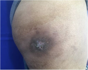 Reducción del 90% de la lesión cutánea.