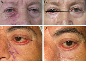 (A) Ectropión de predominio medial, debido a una cicatriz de lámina anterior, probablemente asociado a laxitud de los retractores debido a la edad de la paciente. (B) El tratamiento únicamente mediante cantoplastia, sin abordar ni retractores ni lamela anterior, ocasiona un resultado incompleto, con mejoría del ectropión pero persistencia de una evidente retracción palpebral. (C) Ectropión tarsal completo. La realización de una Z-plastia aislada ofrece un resultado poco satisfactorio como puede observarse comparando con la imagen postoperatoria (D) en la que persiste el ectropión y una evidente inflamación en la superficie ocular (Tomado de Fernández-Canga et al.1).