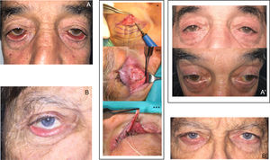Ejemplos de tratamiento completo teniendo en cuenta la fisiopatología del problema. Imágenes de ectropión inferior grave bilateral (A) y derecho (B) con componente involutivo (laxitud de tendón cantal lateral y desinserción de retractores) y cicatricial (acortamiento de lamela anterior por daño actínico crónico). El tratamiento correcto debe combinar diferentes técnicas encaminadas a corregir la etiología del proceso, en estos casos realizamos colgajo heteropalpebral para añadir lamela anterior (*), cirugía de retractores (**) y cirugía del canto lateral (***). (A’ y B’) Imágenes a los 4 meses de la cirugía de los mismos pacientes: se observa una correcta posición de los párpados inferiores, sin ectropión ni retracción residuales, con restitución anatómica y funcional de la superficie ocular.