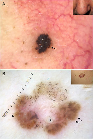 Carcinomas basocelulares con criterios propios de lesiones melanocíticas. A) Lesión intensamente pigmentada de 3 mm con velo azul-blanquecino (asterisco blanco) y glóbulos marrones (flecha negra). B) Patrón multicomponente en un carcinoma basocelular en regresión: múltiples puntos grises (círculo con línea de puntos), proyecciones (flechas negras), áreas en hoja de arce (triángulo) y quiste tipo milia (asterisco); además se aprecian estructuras blancas brillantes y una vascularización polimorfa.