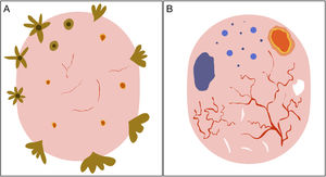 Representación esquemática. A) Carcinoma basocelular superficial: estructuras en hoja de arce, estructuras en rueda de carro, estructuras concéntricas, erosiones múltiples y telangiectasias finas y cortas. B) Carcinoma basocelular no superficial: telangiectasias arboriformes, nido ovoide azul-gris, múltiples puntos y glóbulos azul gris, ulceración y estructuras blanquecinas.