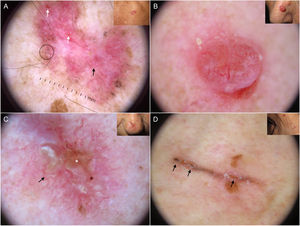 Subtipos de carcinoma basocelular. A) Carcinoma basocelular superficial: áreas en rueda de carro (círculo), telangiectasias finas (flecha negra), múltiples erosiones (flechas blancas); se aprecian además áreas brillantes blanco-rojizas sin estructura y estructuras blanquecinas. B) Carcinoma basocelular nodular: telangiectasias arboriformes y estructuras blanquecinas. C) Carcinoma basocelular morfeiforme con telangiectasias escasamente ramificadas (flecha negra) y de predominio en la periferia del tumor, asociadas a ulceración central (asterisco blanco). D) Carcinoma basocelular lineal con múltiples erosiones (flechas negras), siguiendo un pliegue cutáneo en contexto de cutis romboidal.