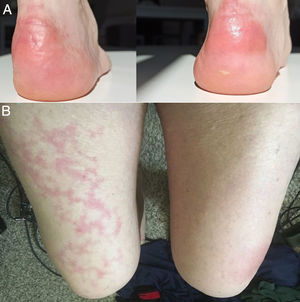 A) Placas eritematoamarillentas infiltradas en talones. Fuente: Estébanez et al.20. B) Hombre de 67años con livedo reticularis unilateral en el muslo derecho. Concomitantemente, el paciente presenta hematuria macroscópica. La hematuria y el livedo resuelven en menos de 24horas. Fuente: Manalo et al.26.