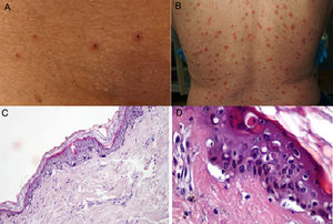 A y B) Pacientes con COVID-19 con exantema papulovesicular en tronco. En la imagen de la izquierda (A) se aprecian vesículas con costra varioliforme central. C y D) Cambios histopatológicos de pacientes con infección por COVID-19 y exantema variceliforme. C) Leve atrofia epidérmica, hiperqueratosis en canasta, degeneración vacuolar de la membrana basal con queratinocitos hipercromáticos multinucleados y disqueratinocitos. HE 10×. D) En mayor aumento se aprecia la alteración vacuolar con queratinocitos desorganizados con maduración alterada, queratinocitos multinucleados con células disqueratóticas. HE 40×. Fuente: Marzano et al.27.