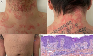 A y B) Placas anulares y circinadas eritematoedematosas en cuello anterior y posterior. C) Se observa patrón simétrico de distribución en miembros superiores. D) Infiltrado linfocítico perivascular superficial, edema de dermis papilar, espongiosis leve, dermatitis de interfase vacuolar y liquenoide, polimorfonucleares ocasionales en el infiltrado dérmico. HE 10×. Fuente: Amatore et al.28.