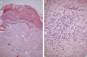 A) Hematoxilina & eosina ×40. B) Hematoxilina & eosina ×400.
