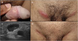 Paciente número 3 con úlcera genital dolorosa en cara interna del prepucio (a) asociado a adenopatías inflamatorias bilaterales inguinales dolorosas (b). La ecografía inguinal mostraba adenopatías de gran tamaño con una cortical asimétrica y poco vascularizadas. Tras el tratamiento con doxiciclina 100mg/cada 12h/durante 21 días, las adenopatías disminuyeron de tamaño dejando una cicatriz residual.