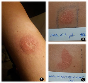 A) Reacción vesiculosa en la zona donde contacta el adhesivo del sensor de glucemia FreeStyle, respetando la zona de material plástico. B) Reacción positiva a IBOA al 0,1% pet a las 96 h. C) Reacción positiva al adhesivo del sensor FreeStyle®.