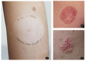 A. Leucoderma adquirida tras el uso con sensor de glucemia FreeStyle. B) Eczema vesiculoso y purpúrico tras el uso con sensor de glucemia FreeStyle. C) Eczema vesiculo-papuloso tras el uso con sensor de glucemia FreeStyle®.