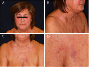 Imágenes clínicas. A). Edema y eritema periocular y bimalar. B y C) Edema en esclavina, llamativo en la región cervical y región clavicular. D) Circulación venosa colateral en región esternal.