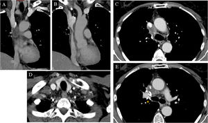 Tomografía computarizada pulmonar del primer caso. Cortes coronales (A) y (B) y axiales (C-E) en ventana mediastínica. Se observa la presencia de una masa infiltrante que engloba y estenosa la vena cava superior desde el nivel del cayado de la vena ácigos hasta su entrada en la aurícula derecha (flechas y círculos amarillos). La imagen D muestra una adenopatía hipodensa en hueco supraclavicular derecho (cabeza de flecha). Clips quirúrgicos en relación con antecedente de lobectomía superior derecha (asterisco).