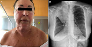 Imagen clínica y radiografía del segundo caso. A) Eritema facial y edema en esclavina. B) Radiografía de tórax postero-anterior. Signo de la «S» de Golden. Atelectasia obstructiva del lóbulo superior derecho en el contexto de masa pulmonar hiliar derecha. Derrame pleural derecho.
