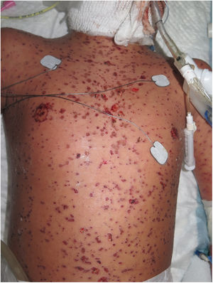 Múltiples ampollas, erosiones y costras de distribución generalizada con importante afectación de mucosa oral. ,