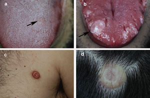 Aspecto clínico del TCG en 4 pacientes: a) lesión incipiente en la lengua de 5mm de diámetro; b) lesión nodular exofítica de mayor tamaño en la lengua, de coloración blanquecina debido a hiperplasia epitelial suprayacente; c) lesión nodular localizada en el tronco de coloración eritematosa; d) lesión nodular en el cuero cabelludo con coloración amarillenta y telangiectasias.