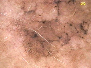 Se enfatizan las líneas anguladas en un melanoma in situ, definidas como líneas pigmentadas que forman estructuras romboidales o en zig-zag.