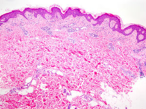 Urticaria crónica espontánea (HE×4). Se observa la epidermis sin alteraciones, y un infiltrado linfohistiocitario perivascular superficial junto a edema en la dermis papilar.