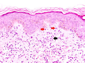 Dermatosis neutrofílica urticarial (HE×40). Se observa un infiltrado intersticial, perivascular superficial, y en la unión dermoepidérmica en el que predominan los neutrófilos (flechas rojas). También se observa leucocitoclasia (flecha negra). No se objetivan trombos ni necrosis o edema de la pared vascular. Los hallazgos fueron compatibles con una dermatosis neutrofílica urticarial, y finalmente la paciente fue diagnosticada de síndrome de Sjögren.
