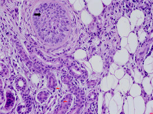 Dermatosis neutrofílica urticarial (HE×40). Se observa la presencia de un infiltrado linfohistiocitario perianexial con presencia de neutrófilos en las glándulas sudoríparas ecrinas (flechas rojas) y en el epitelio del folículo piloso (flecha negra), así como polvo nuclear. El paciente fue diagnosticado de fiebre mediterránea familiar.