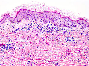 Dermatitis urticarial (HE×10). Se observa espongiosis epidérmica, discreta exocitosis junto a un infiltrado perivascular superficial e intersticial compuesto principalmente por linfocitos, con aislados eosinófilos. No se objetivan trombos ni necrosis o edema de la pared vascular.