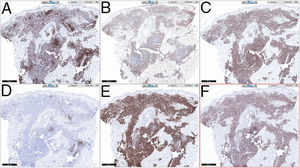 A: CD45; B: CD1a; C: CD43; D: CD123; E: CD56; F: CD4 (x 2).