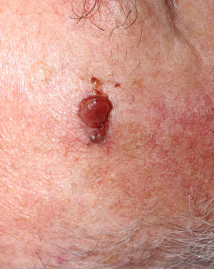 Tumoración exofítica ulcerada en sien derecha, compatible con fibroxantoma atípico tras su análisis histopatológico.